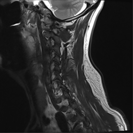 File:Normal MRI cervical spine (infection protocol) (Radiopaedia 53916-60039 Sagittal T2 14).png