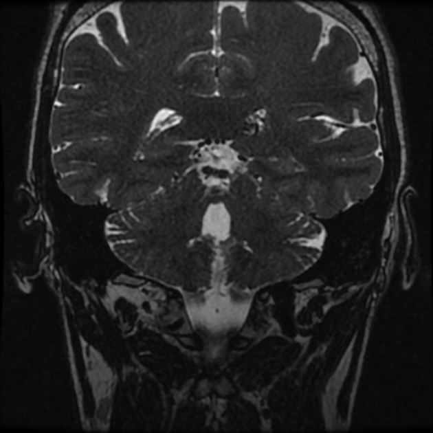 Normal MRI petrous (Radiopaedia 91317-108949 Coronal T2 82).jpg