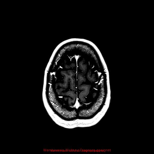 Normal adult brain MRI (non-enhanced and contrast-enhanced) (Radiopaedia 75262-86379 Axial T1 C+ 160).jpg