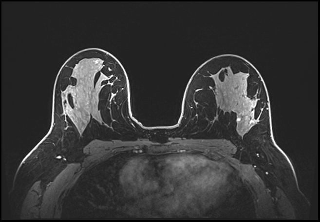 Normal breast MRI - dense breasts (Radiopaedia 80454-93850 C 128).jpg