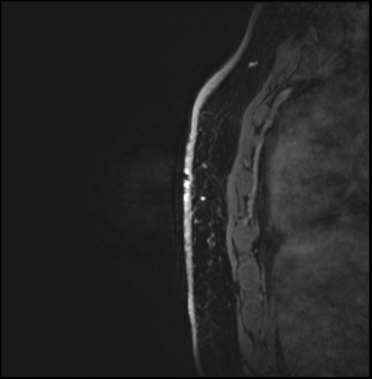 Normal breast MRI - dense breasts (Radiopaedia 80454-93850 I 157).jpg