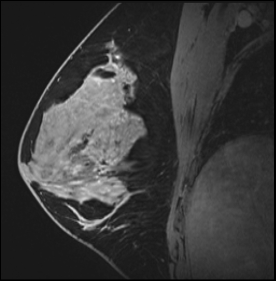 Normal breast MRI - dense breasts (Radiopaedia 80454-93850 I 90).jpg