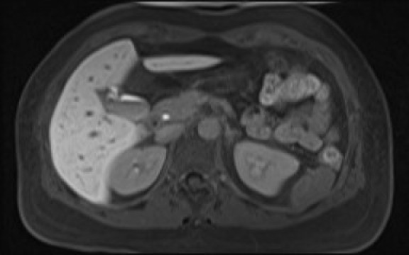 File:Normal hepatobiliary phase liver MRI (Radiopaedia 58968-66230 A 48).jpg