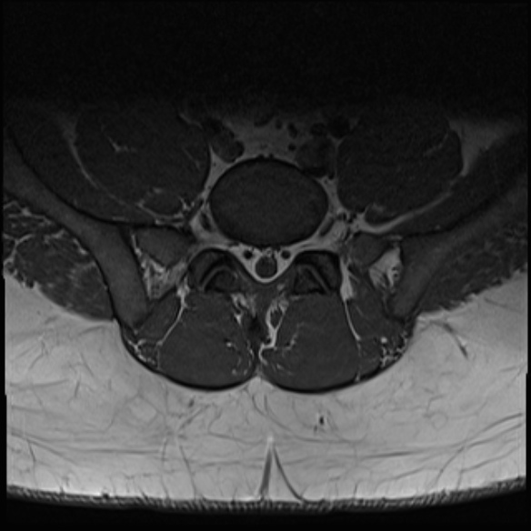 File:Normal lumbar spine MRI (Radiopaedia 47857-52609 Axial T1 27).jpg