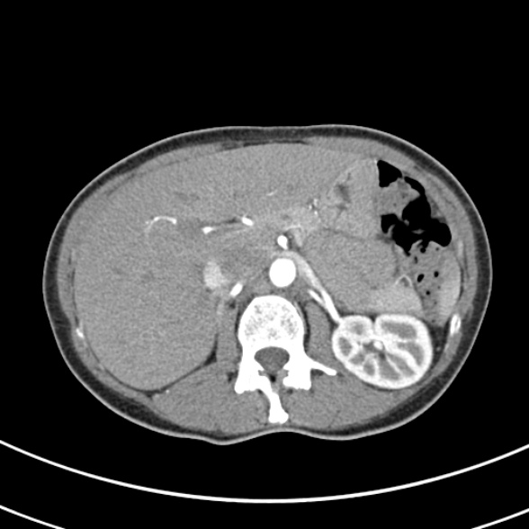 File:Normal multiphase CT liver (Radiopaedia 38026-39996 B 26).jpg