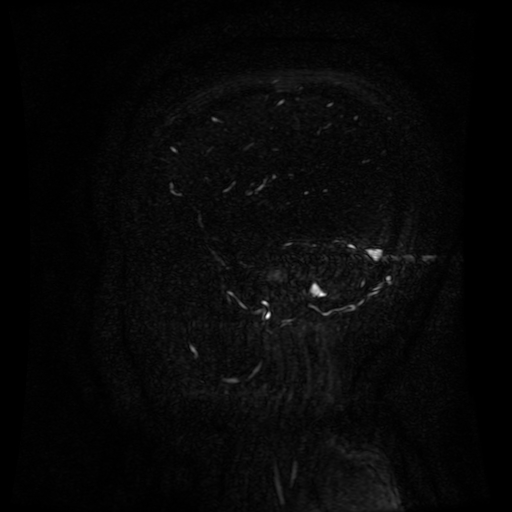 Normal noncontrast MR venography (Radiopaedia 87578-103957 A 31).jpg