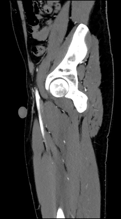 Normal pelvis CT angiogram (Radiopaedia 84966-100481 C 78).jpg
