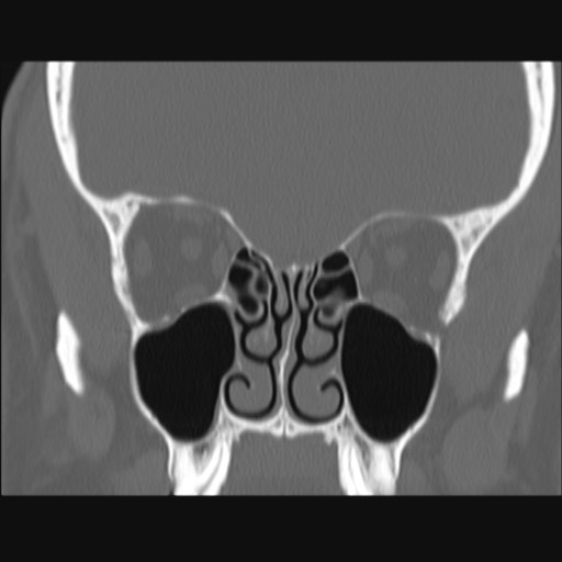 Normal sinus CT (annotated) (Radiopaedia 78917-91810 Coronal bone window 30).jpg