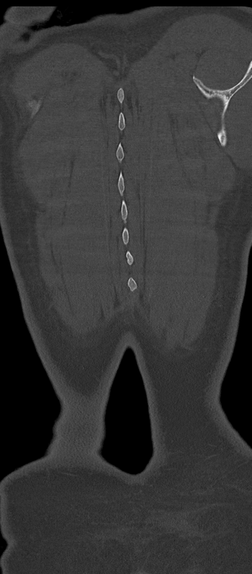 Normal thoracolumbar spine (Radiopaedia 43822-47309 Coronal bone window 88).png