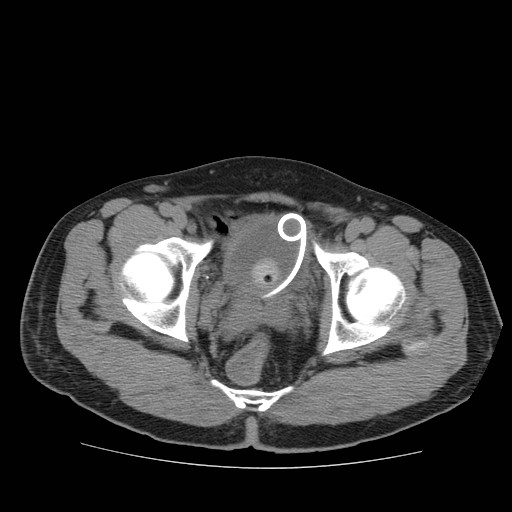 File:Obstructed kidney with perinephric urinoma (Radiopaedia 26889-27067 Axial non-contrast 37).jpg