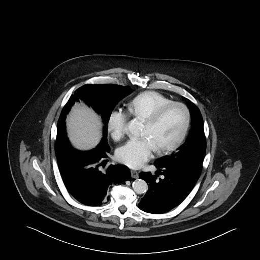 Obstructing sigmoid adenocarcinoma (Radiopaedia 58465-65619 A 8).jpg