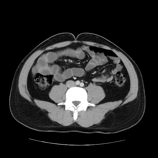 File:Obstructing ureteric calculus (Radiopaedia 18615-18514 B 33).jpg