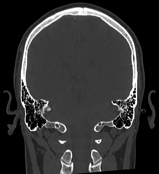 Occipital spur and Currarino type A atlas anomaly (Radiopaedia 87027-103285 Coronal bone window 99).jpg