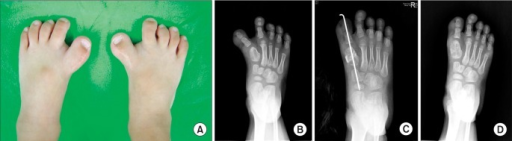 a) Preoperative photograph showing bilateral hallux varus with widening of the first web space b) Preoperative radiograph of the right foot at 58 months of age c,d) at the immediate postoperative follow-up and final