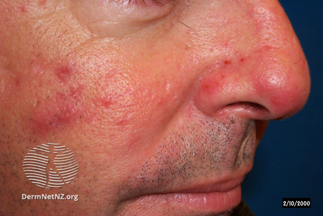 Rosacea (DermNet NZ acne-red-face-3613).jpg