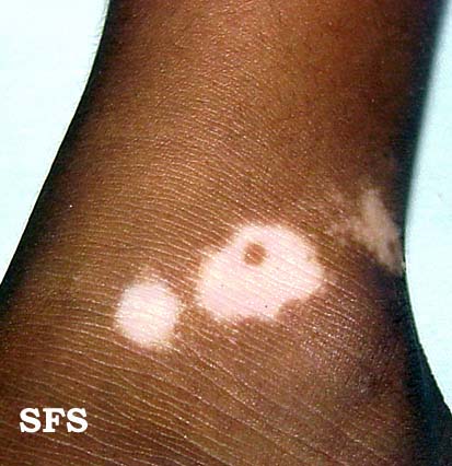 File:Vitiligo (Dermatology Atlas 4).jpg