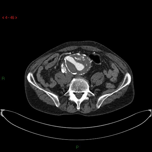 File:Abdominal aortic aneurysm (Radiopaedia 16155-15834 Axial C+ arterial phase 26).jpg