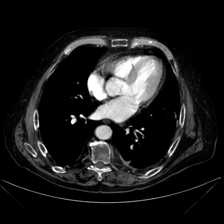 Abdominal aortic aneurysm (Radiopaedia 25855-26001 Axial C+ arterial phase 5).jpg