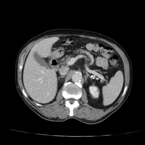Abdominal aortic aneurysm (Radiopaedia 29248-29660 Axial C+ portal venous phase 21).jpg