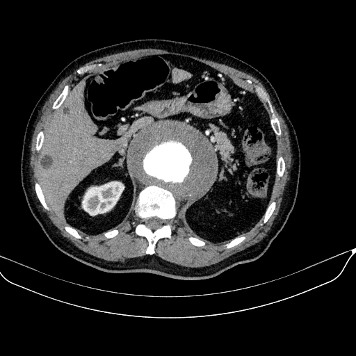 Abdominal aortic aneurysm (Radiopaedia 67117-76452 Axial C+ arterial phase 39).jpg