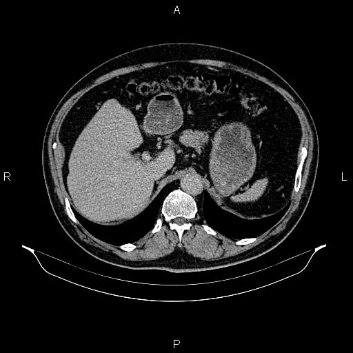 Abdominal aortic aneurysm (Radiopaedia 83094-97462 Axial renal excretory phase 31).jpg