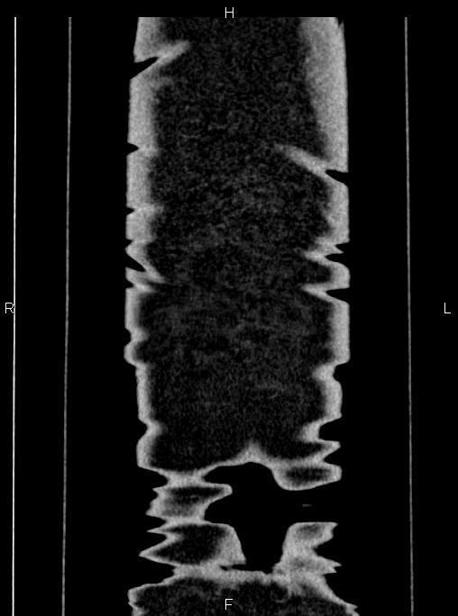 Abdominal aortic aneurysm (Radiopaedia 83094-97462 Coronal renal cortical phase 95).jpg