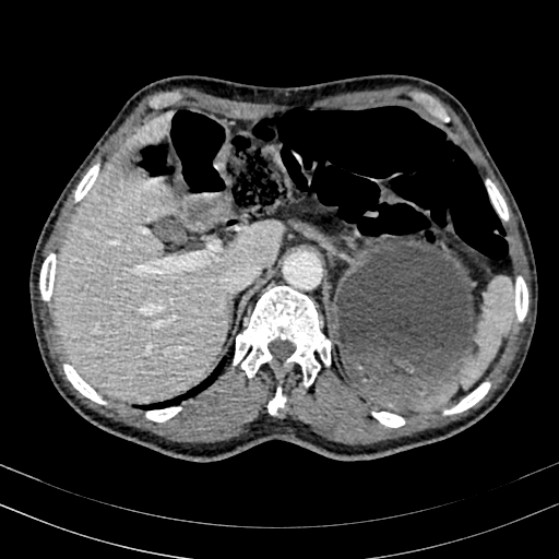 Abdominal aortic aneurysm (Radiopaedia 83581-98689 Axial C+ portal venous phase 26).jpg