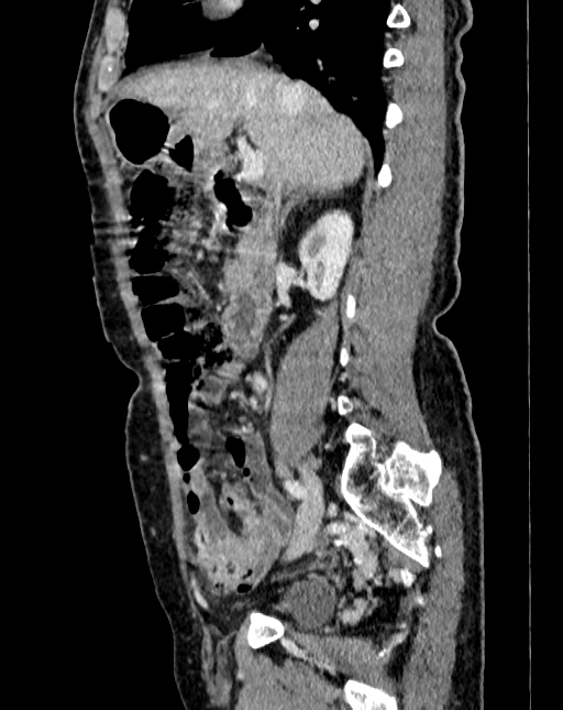 Abdominal aortic aneurysm (Radiopaedia 83581-98689 Sagittal C+ portal venous phase 19).jpg