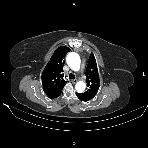 File:Abdominal aortic aneurysm (Radiopaedia 85063-100606 Axial C+ arterial phase 13).jpg