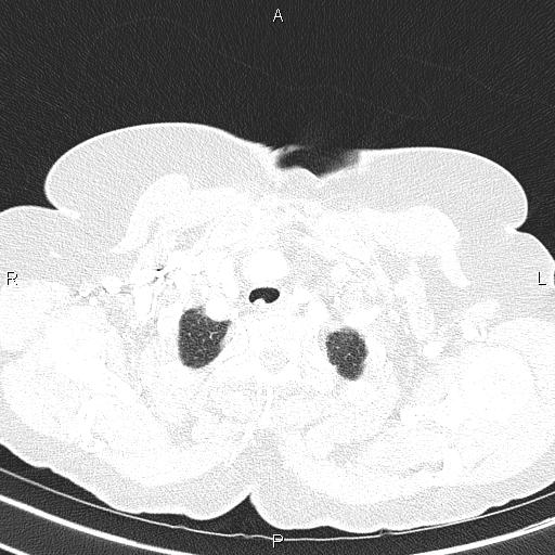 Abdominal aortic aneurysm (Radiopaedia 85063-100606 Axial lung window 12).jpg