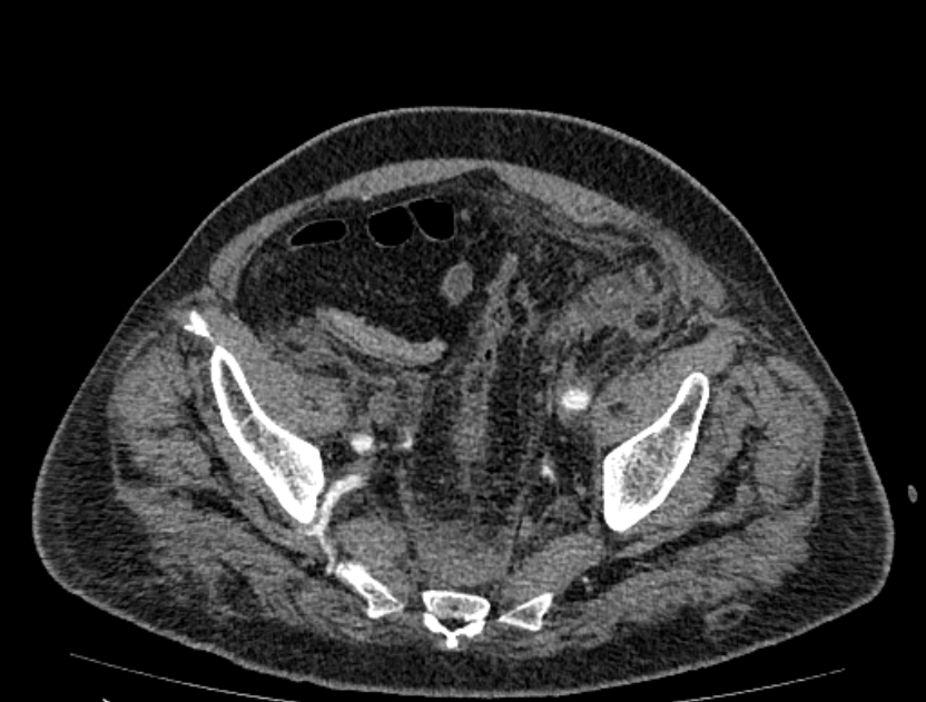 Abdominal aortic aneurysm rupture (Radiopaedia 54179-60362 Axial C+ portal venous phase 5).jpg