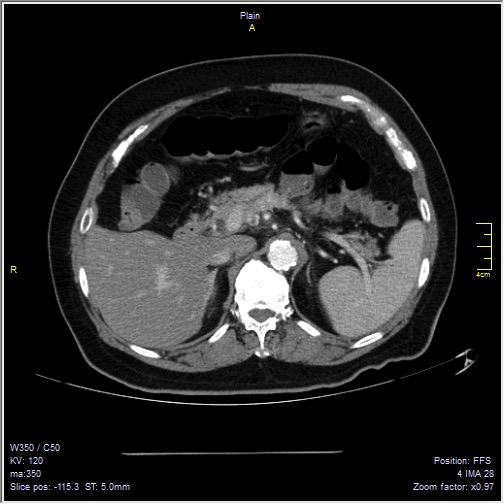 Abdominal aortic aneurysm with thrombus fissuration (Radiopaedia 47340-51926 Axial C+ arterial phase 12).jpg