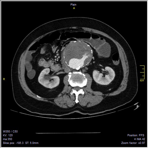Abdominal aortic aneurysm with thrombus fissuration (Radiopaedia 47340-51926 Axial C+ arterial phase 26).jpg