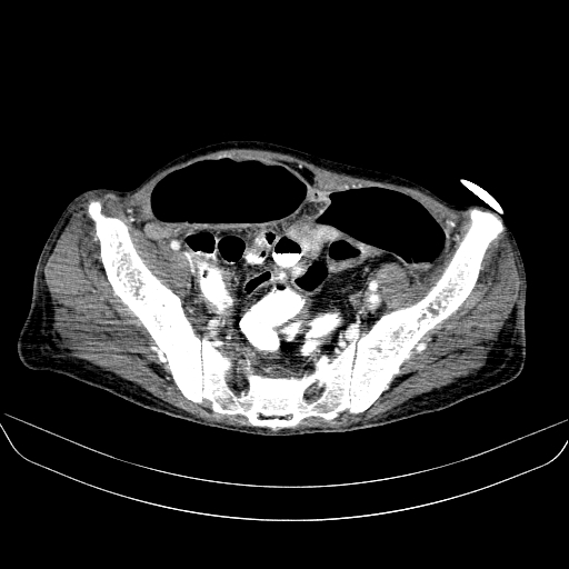 File:Abdominal collection due to previous cecal perforation (Radiopaedia 80831-94320 Axial C+ portal venous phase 167).jpg