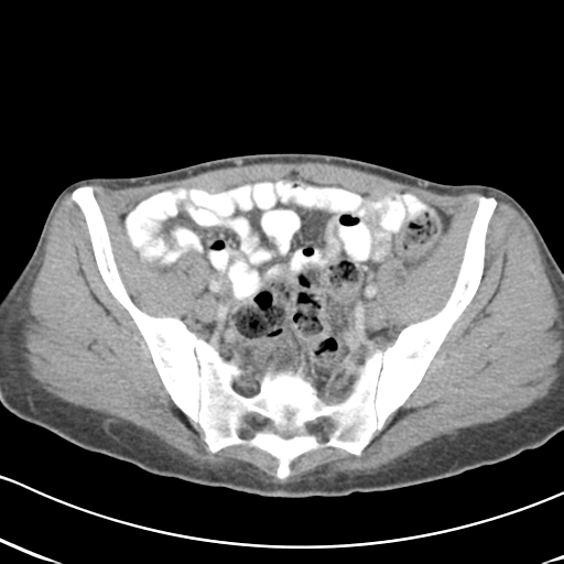 Abdominal desmoid tumor (Radiopaedia 41007-43740 Axial C+ portal venous phase 56).png