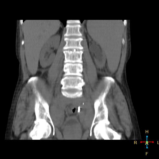 File:Abdominal lymphoma (Radiopaedia 23085-23115 Coronal non-contrast 8).jpg