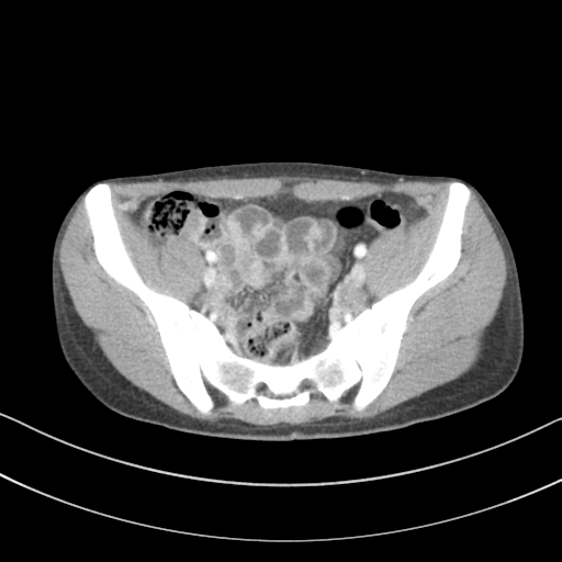 File:Abdominal multi-trauma - devascularised kidney and liver, spleen and pancreatic lacerations (Radiopaedia 34984-36486 Axial C+ portal venous phase 65).png