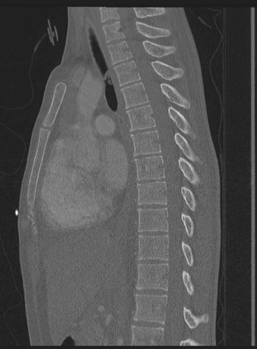 Abdominal multi-trauma - devascularised kidney and liver, spleen and pancreatic lacerations (Radiopaedia 34984-36486 Sagittal bone window 33).png