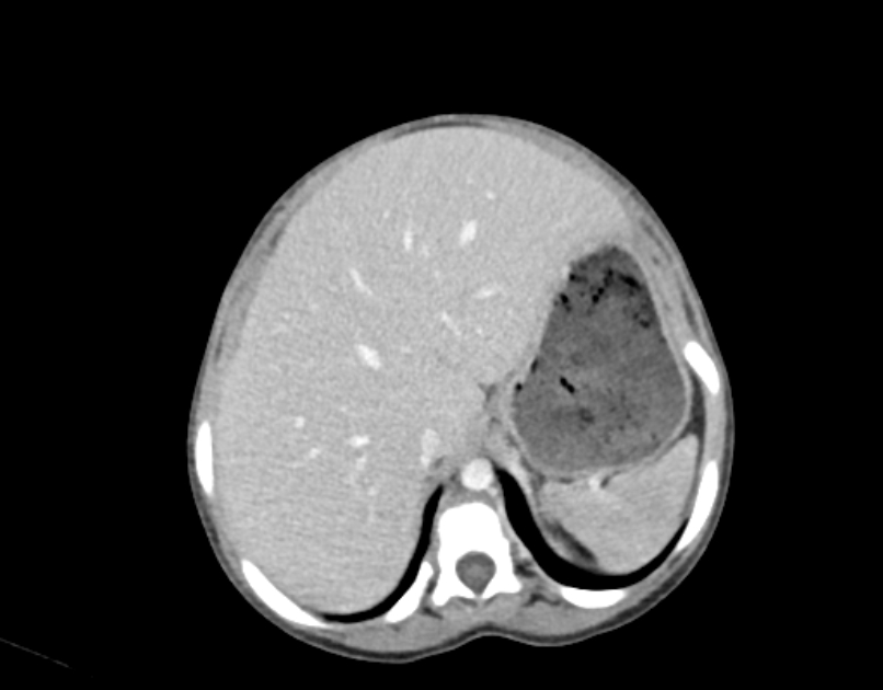 Abdominal premesenteric cystic lymphangioma (Radiopaedia 82995-97350 Axial C+ portal venous phase 8).jpg