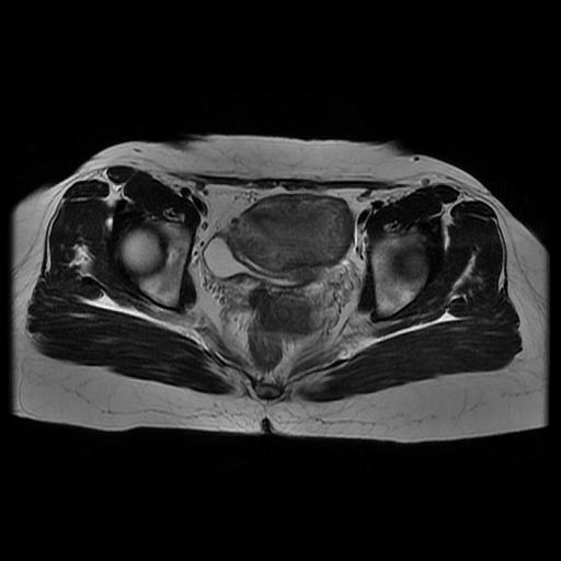 File:Abdominal wall endometriosis (Radiopaedia 83702-98847 Axial T2 12).jpg