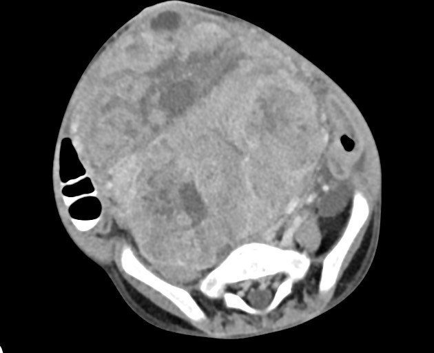 Abdominopelvic rhabdomyosarcoma (Radiopaedia 78356-90984 Axial C+ portal venous phase 118).jpg