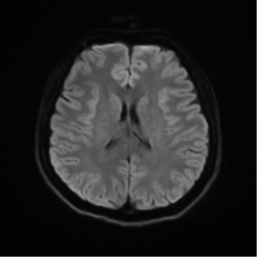 Abducens nerve palsy (Radiopaedia 51069-56648 Axial DWI 43).png