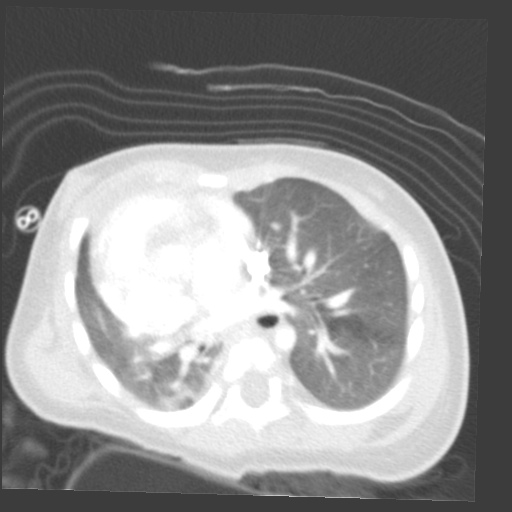 File:Aberrant left pulmonary artery (pulmonary sling) (Radiopaedia 42323-45435 Axial lung window 21).jpg