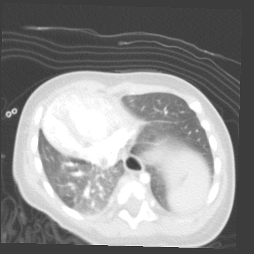 File:Aberrant left pulmonary artery (pulmonary sling) (Radiopaedia 42323-45435 Axial lung window 28).jpg
