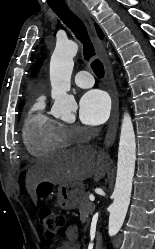 Accessory left atrial appendage (Radiopaedia 81987-95968 Sagittal C+ arterial phase 59).jpg