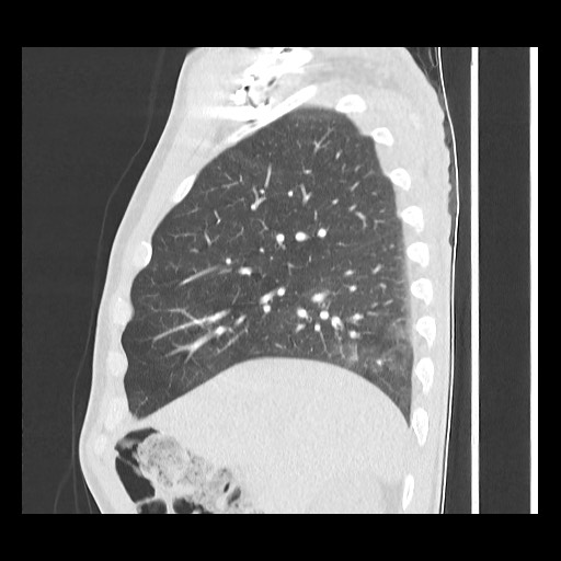 Accessory left horizontal fissure with lingular pneumonia (Radiopaedia 53763-59843 Sagittal lung window 22).jpg