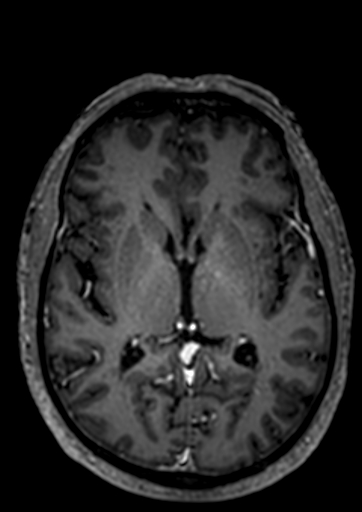 Accessory middle cerebral artery (Radiopaedia 73114-83828 Axial T1 C+ 29).jpg