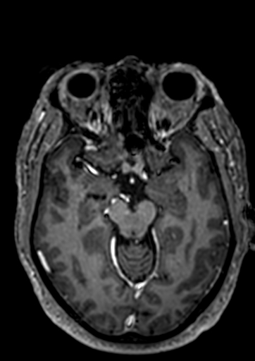 Accessory middle cerebral artery (Radiopaedia 73114-83828 Axial T1 C+ 75).jpg