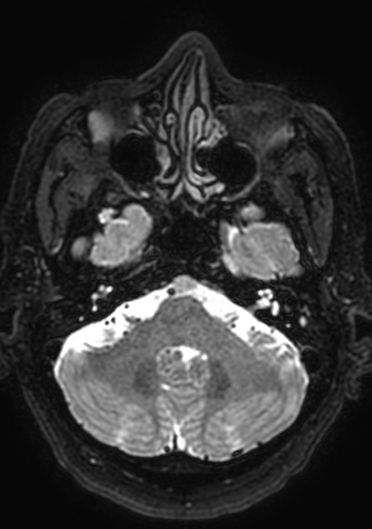 Accessory middle cerebral artery (Radiopaedia 73114-83828 Axial T2 171).jpg