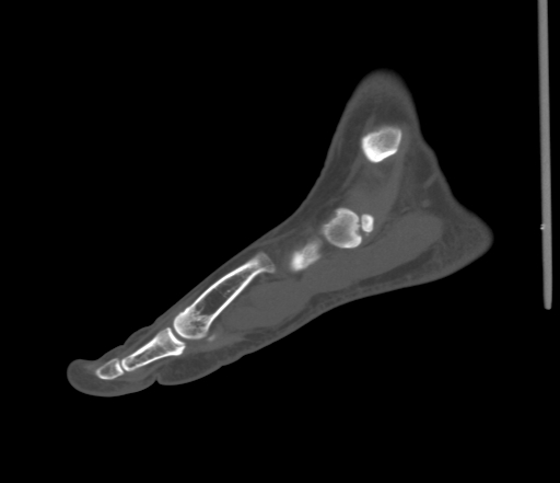 File:Accessory navicular bone (Radiopaedia 54999-61314 Sagittal non-contrast 28).jpg